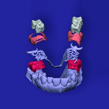 Dental CAD - EXOCAD